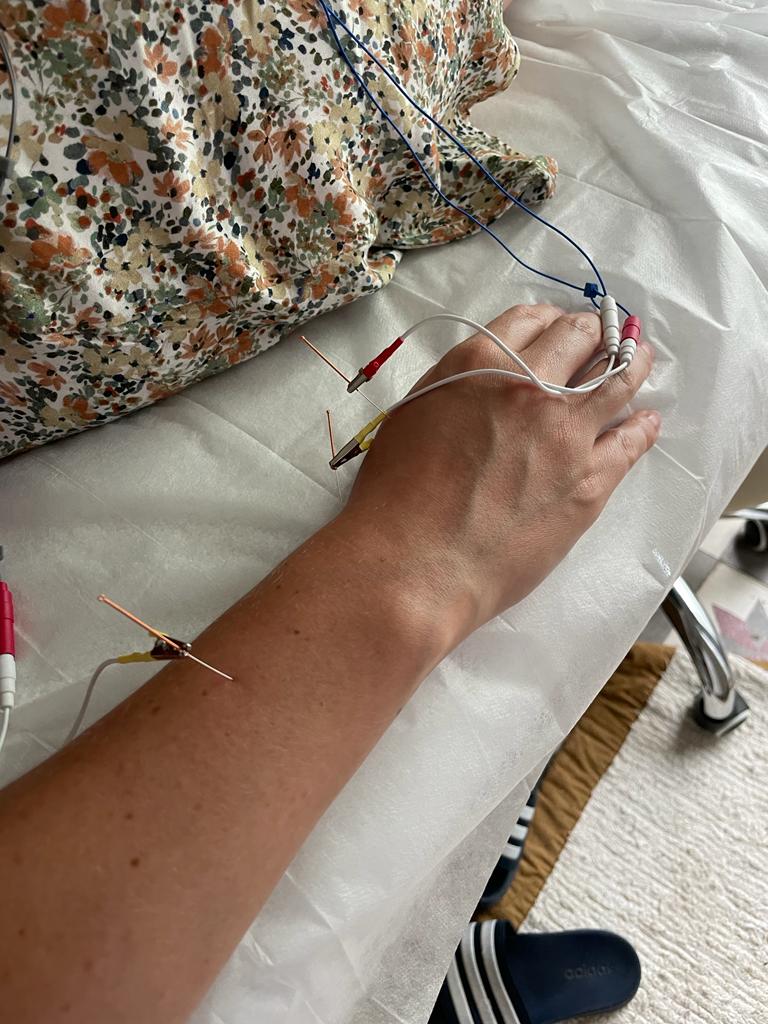 Sesión de electroacupuntura aplicada en el brazo y la mano