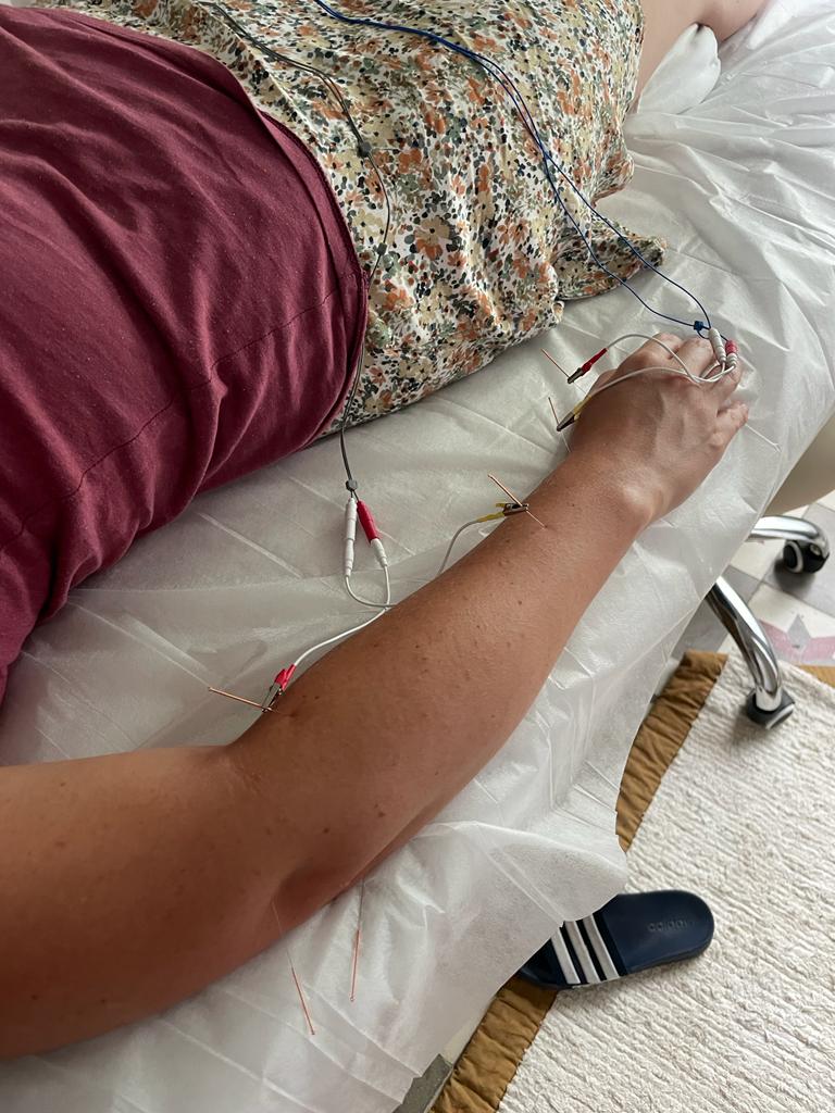 Aplicación de electroacupuntura en el brazo de una paciente