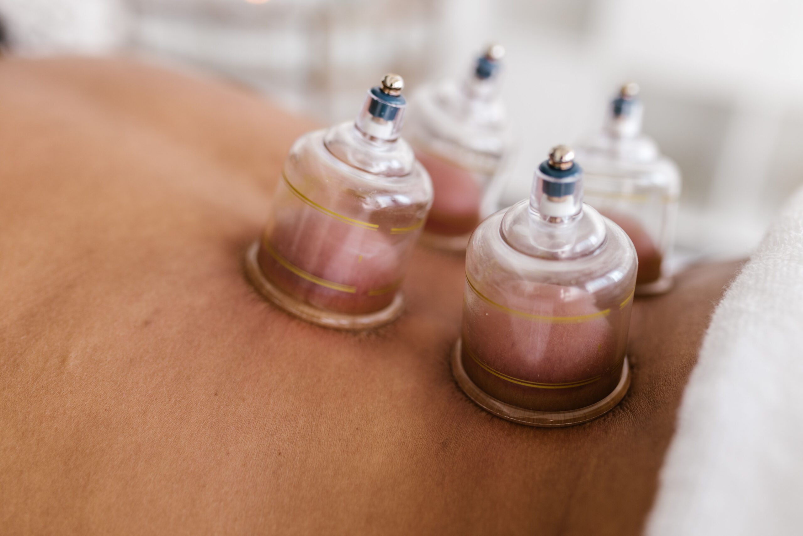 Sesión profesional de terapia con ventosas